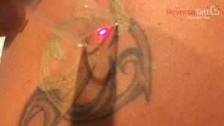 ReversaTatt Tattoo Removal