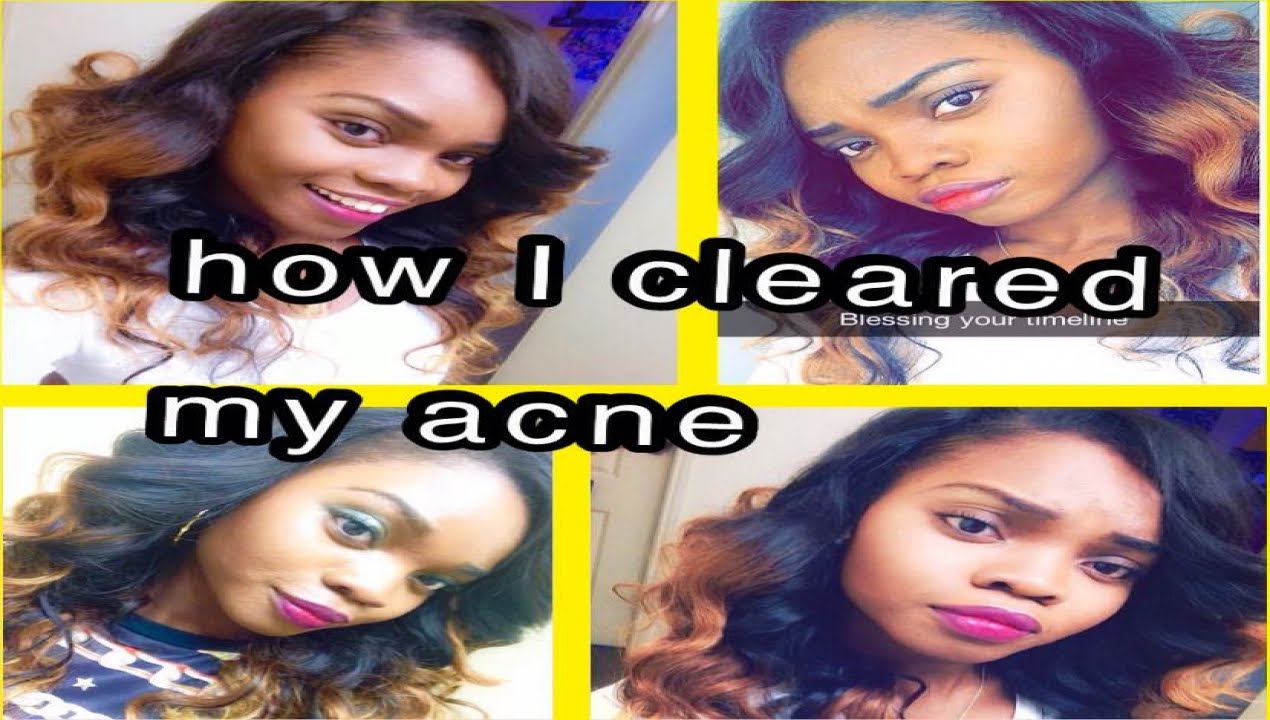 My acne scars are GONE ! African Black soap, Best treatment for Acne