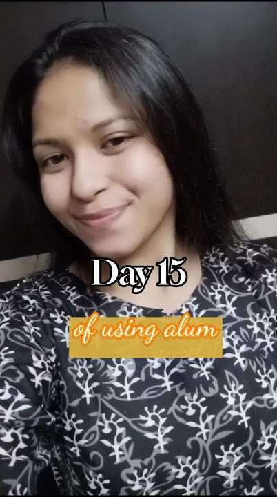 Day 15/15 of using alum for curing acne or pimples #youtubeshorts #shorts #skincare
