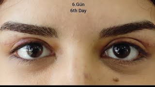 Üst Göz Kapağı Ameliyatı Upper Eyelid Surgery