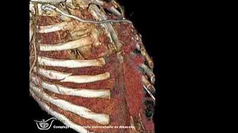 ¿Qué es lo más afectado por las lesiones costales?