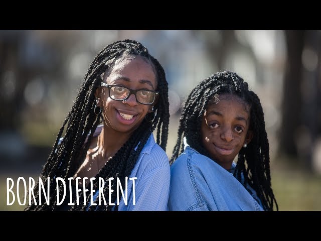 Inspirational Sisters Share Rare Facial Disorder | BORN DIFFERENT class=