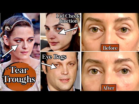 Tear Trough Filler Before and After | How Filler helps Under-Eye Darkness and Eye Bags