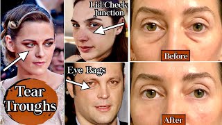 Tear Trough Filler Before and After | How Filler helps Under-Eye Darkness and Eye Bags