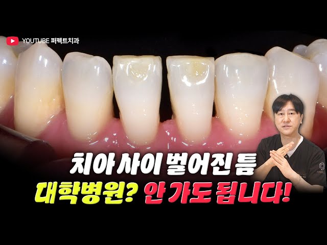치아 사이 까만틈 & 블랙트라이앵글 이렇게 해결했습니다!