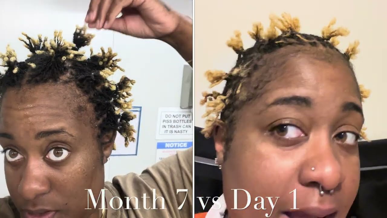 6th retie, month 7 sisterlock update(overseas) Dec 2025