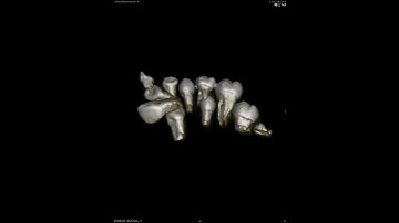 CT Volumetric Rendering of Impacted Maxillary Central Incisor 3