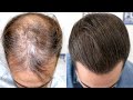 Fue hair transplant 3586 grafts nw v vertex by dr juan couto  fuexpert clinic  madrid spain