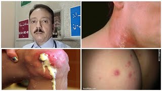 MOST EFFECTIVE FURUNCLE TREATMENT HINDI/URDU I FURUNCLE HOMEOPATHIC TREATMENT I PHODE/PHUNSI KA ILAJ