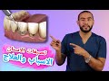 تصبغات الاسنان السوداء اسبابها وعلاجها علاج تصبغات الاسنان عند الاطفال علاج تصبغات الاسنان بالليزر