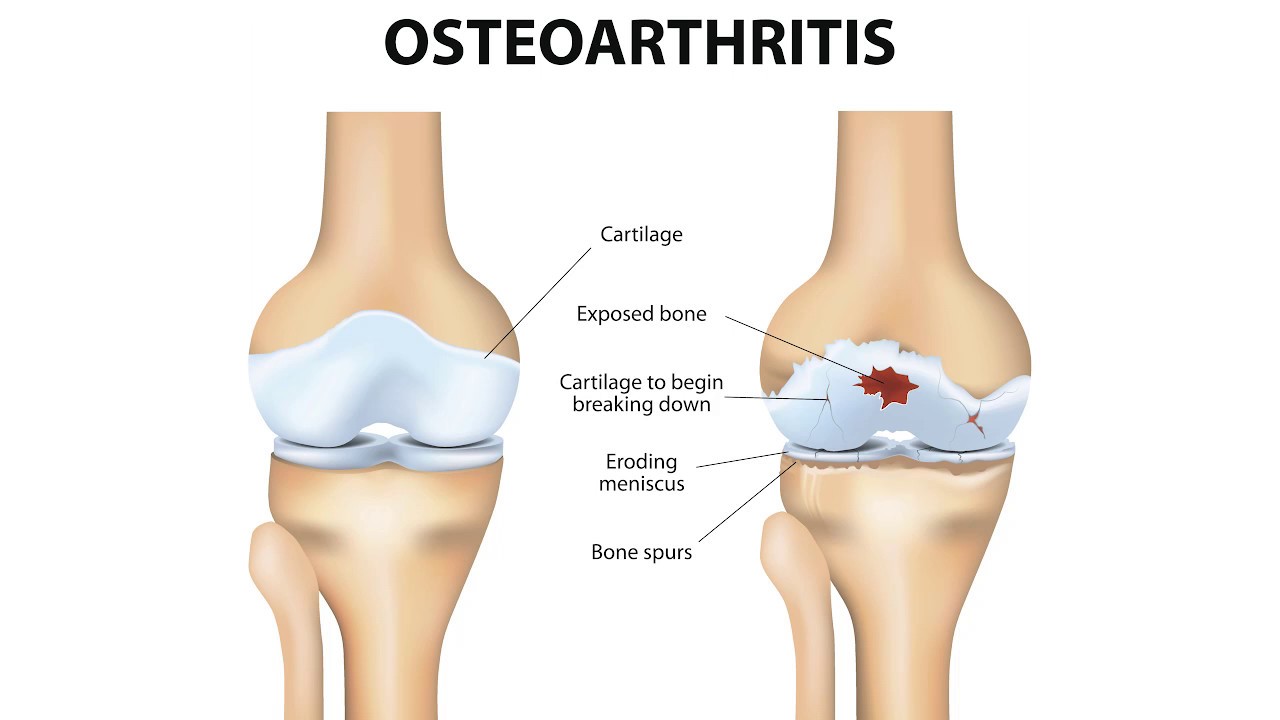 Остеоартроз это. Деформирующий остеоартроз (доа). Первичный деформирующий остеоартроз. Заболевания коленного сустава остеоартроз. .Деформирующий остеоартрит остеоартроз.