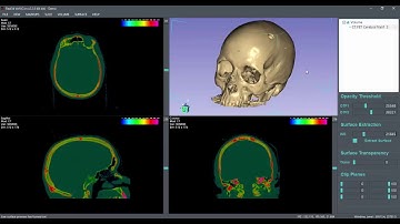 Real3d VolViCon Features Including Markups/Landmarks/Labels