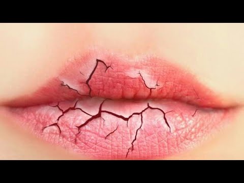 Lips crack, lips chapped ki Homeopathy medicine. - YouTube
