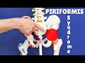 Piriformis Test & Simple Treatment That Works; Everything You Need to Know!