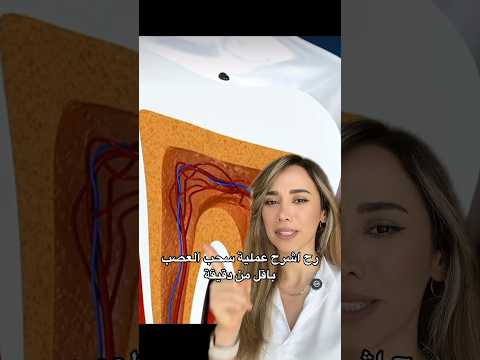 قصة سحب العصب اكسبلور   اسنان