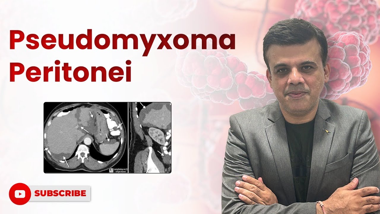 Demystifying Pseudomyxoma Peritonei Causes Symptoms And Treatment demystifying-pseudomyxoma-peritonei-causes-symptoms-and-treatment