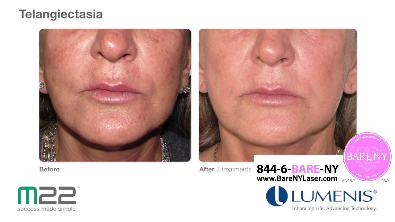 Cosmetic Surgery Before and After Photos at Cosmetic Surgery Before and After Photos at