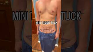 MINI TUMMY TUCK! Stay tuned to see how it’s done. #bodytransformation #male #tummytuck #body