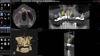 Viršutinio žandikaulio dantų implantacija klinikoje &quot;Papadent&quot;