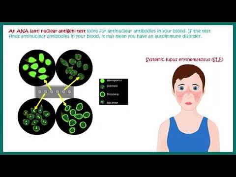 Antinuclear Antibodies ANA test and their patterns ANA test What does Antinuclear Antibodies ANA test and their patterns ANA test What does