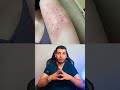 اختبار الحساسية حساسية حساسية الجلد جلدية اكزيما ربو بنسلين النحل د مصعب حسوا ثقف نفسك طبيا