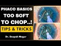 Phaco basics too soft to chop tips  tricks  dr deepak megur