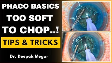 Phaco Basics- Too Soft to CHOP..! Tips & Tricks - Dr. Deepak Megur