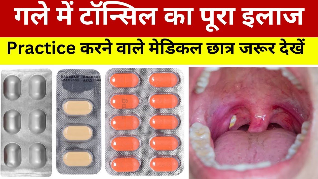 Tonsil Stone Treatment In Hindi टॉन्सिल कैसे निकाला जाता है टॉन्सिल