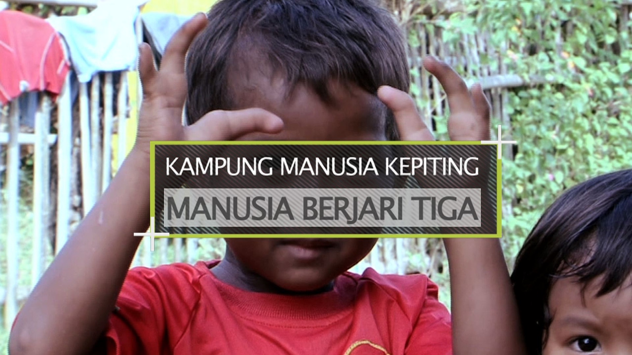 Unik dan Nyata "Kampung Manusia Kepiting", Manusia Berjari Tiga