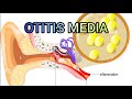 Otitis Media(Middle Ear Infection), Definition,Types, Causes, Symptoms, Diagnosis, Management