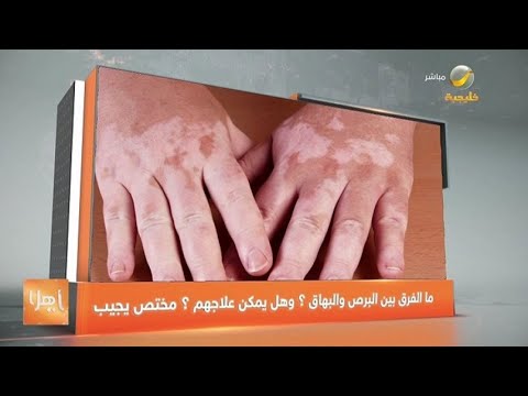 ما الفرق بين البرص والبهاق وهل يمكن علاجهم استشاري يجيب