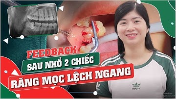 SAU NHỔ 2 CHIẾC RĂNG KHÔN MỌC LỆCH 90 ĐỘ.| Nhổ răng tại Nha khoa Italiano|