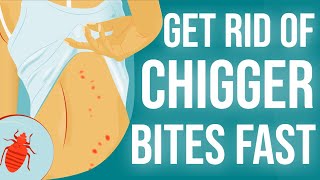 How To Get Rid of Chigger Bites in 2024
