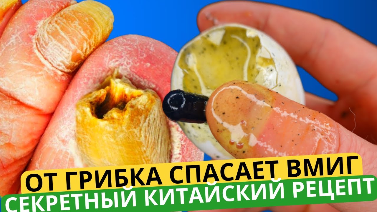 КИТАЙСКИЙ ЯДРЕНЕЙШИЙ РЕЦЕПТ: ГРИБОК Ногтей ИСЧЕЗНЕТ СРАЗУ И НАВСЕГДА ...