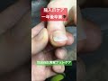 陥入爪ケア