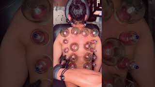Dry Cupping (Hijama) Therapy for Back Pain Relief | Full Treatment Process