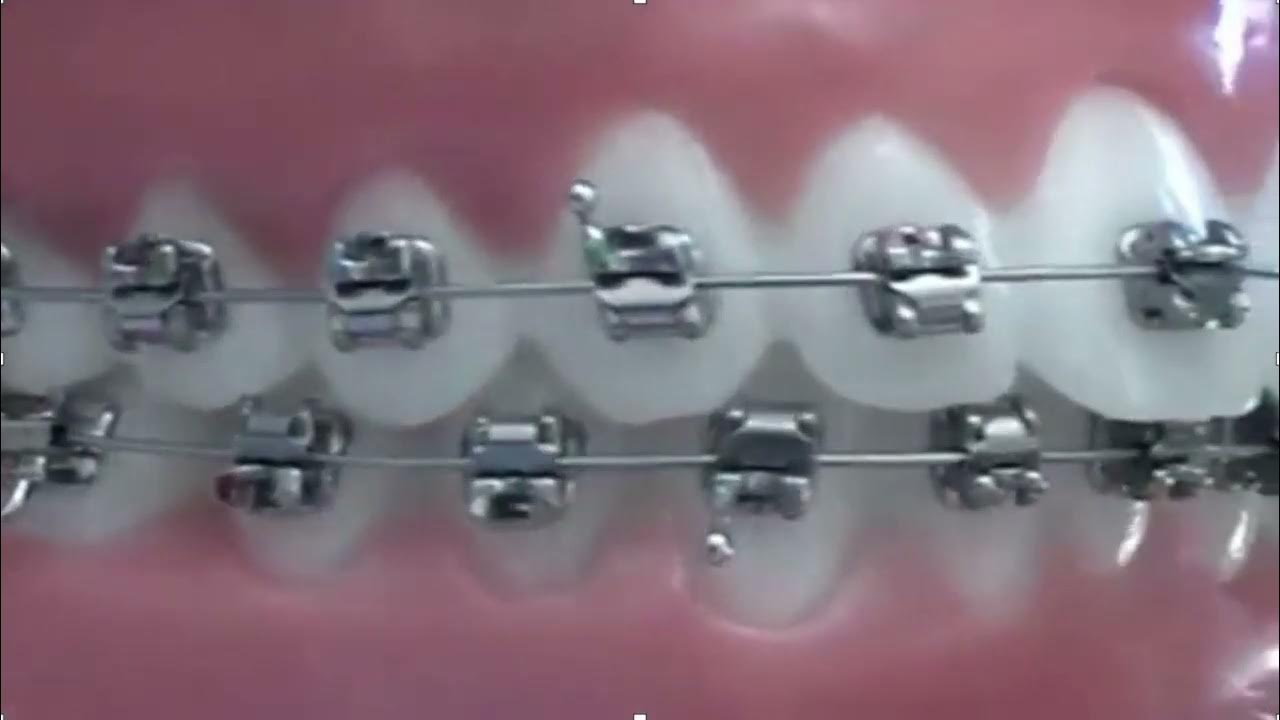 Cómo abrir correctamente los brackets CCO YouTube