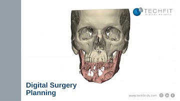 Digital Surgery Planning for Mandible reconstruction