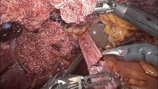 First Fully Robotic Liver Transplant, Beth Israel Deaconess Medical Center, Harvard Medical School.
