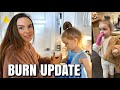 Our Daughter’s 3rd Degree Burn Update