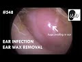 548 - Ear Infection Ear Wax Removal