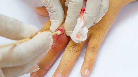 Incision and drainage Abscess CPT  code - simplify medical coding