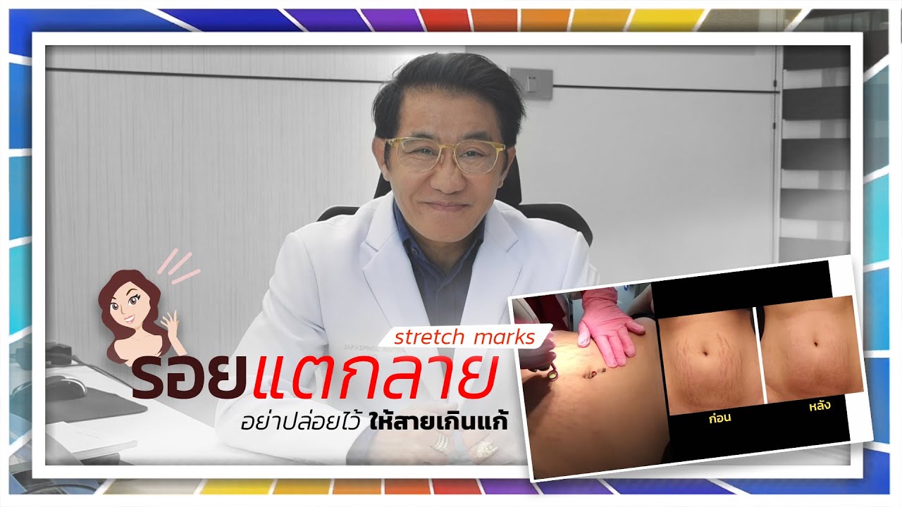 ครีม แก้ ท้อง ลาย ยี่ห้อ ไหน ดี  2022  \