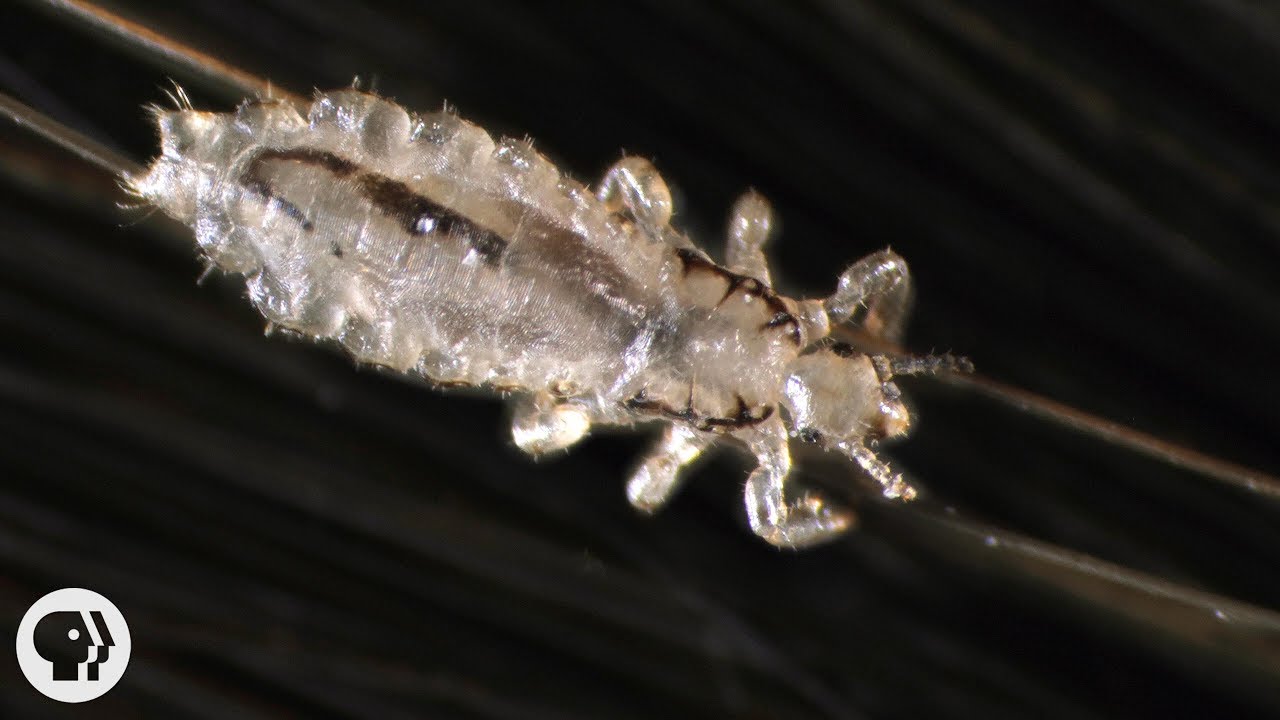 Head lice Causes symptoms and treatments