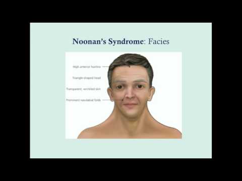 Video: Noonans Syndrom - Orsaker, Symtom Och Behandling