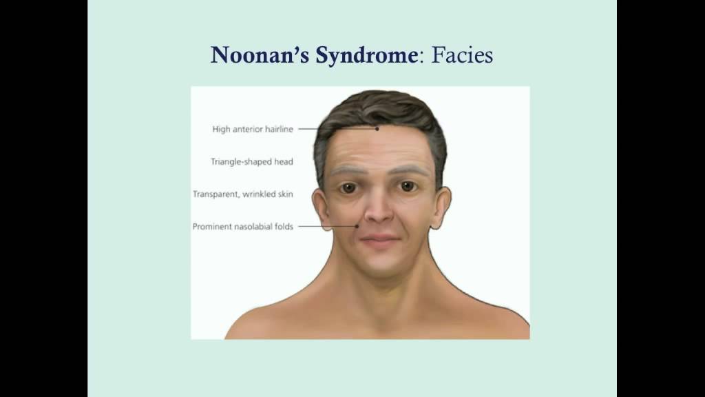 Noonan's Syndrome - CRASH! Medical Review Series - YouTube