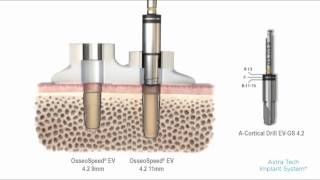 Astra Tech Dental Implant DrillKit 新品未使用 mqdefault.jpg