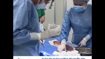 Tháo túi ngực nhám không rõ nguồn gốc và bóc bao xơ độ 3,4 sau nâng ngực 7 năm.