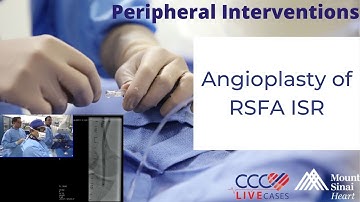 Angioplasty of RSFA ISR - April 27, 2016 Live Case