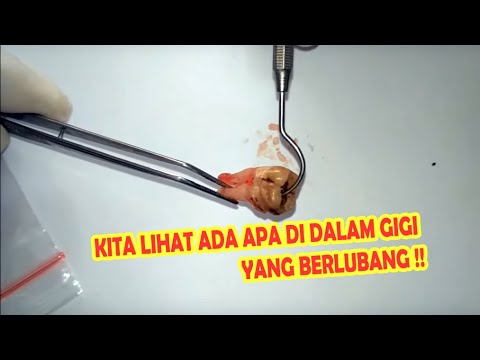 Jangan Percaya Ulat Gigi  Berlubang Gak Ada Ini 